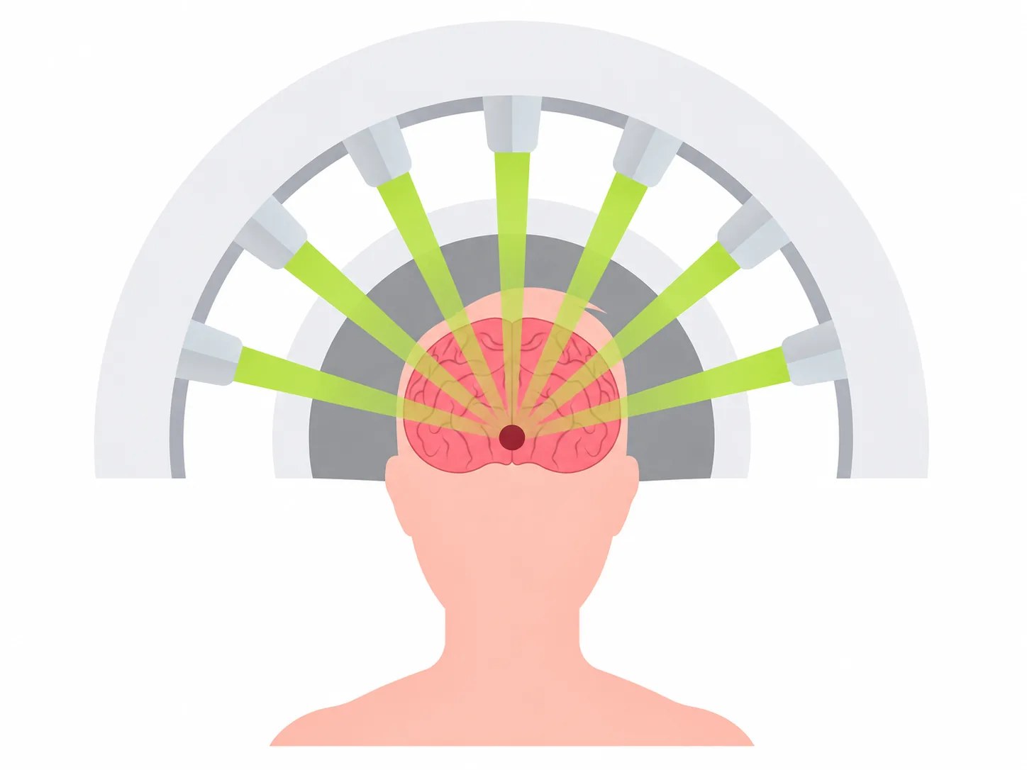 Gamma Knife beams converging on a brain target
